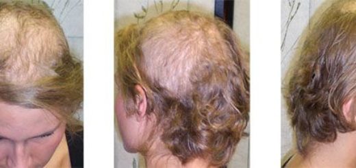 اختلال مو کندن یا تریکوتیلومانی